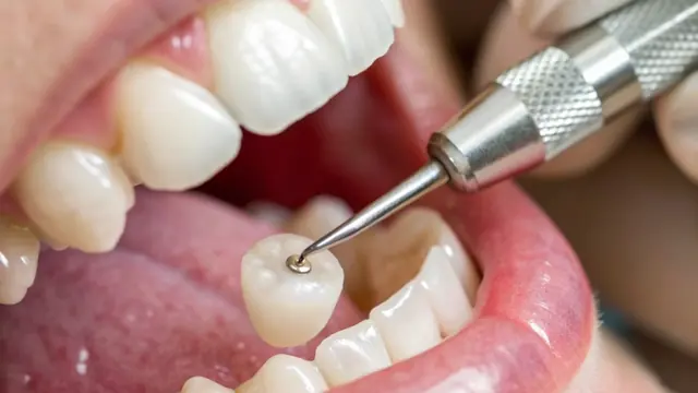 Dental crown being fitted