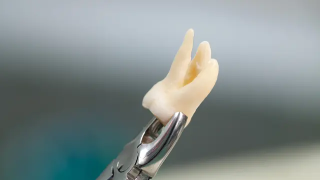 Extracted tooth in forceps
