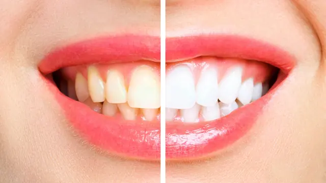Teeth before and after whitening