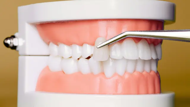 Veneers on a tooth model